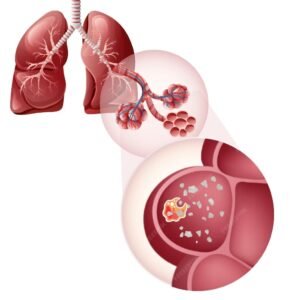 Human lung with trapped silica dust.